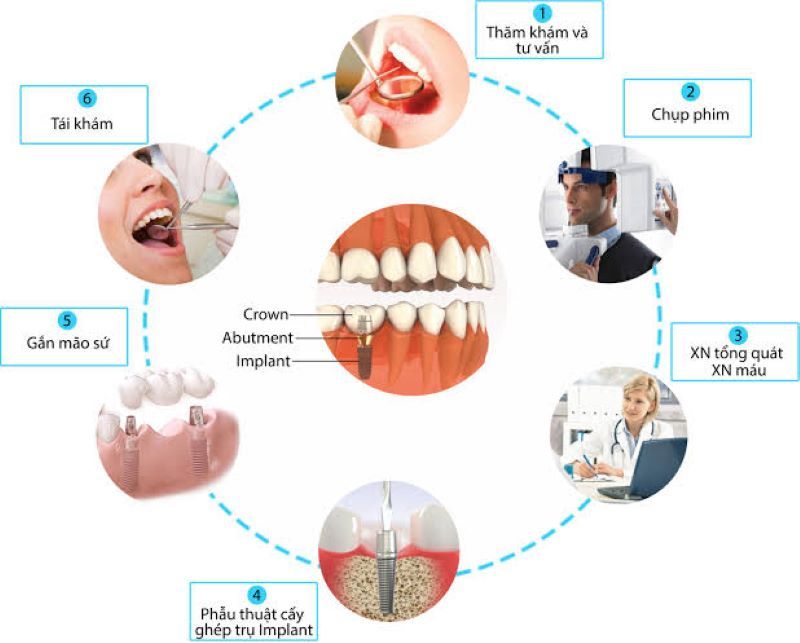 địa chỉ trồng răng implant tốt uy tín Phường Tân Sơn Nhì TPHCM 5