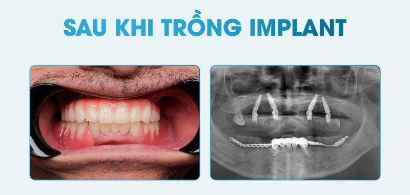Bệnh viện Worldwide điều trị Implant toàn hàm chuyên sâu