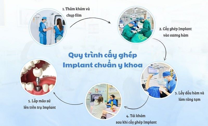 địa chỉ trồng răng implant tốt uy tín Phường Phú Thọ Hòa TPHCM