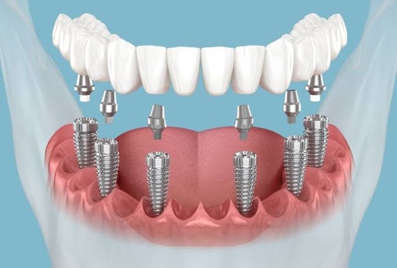 địa chỉ trồng răng implant tốt uy tín Phường Tân Phú TPHCM