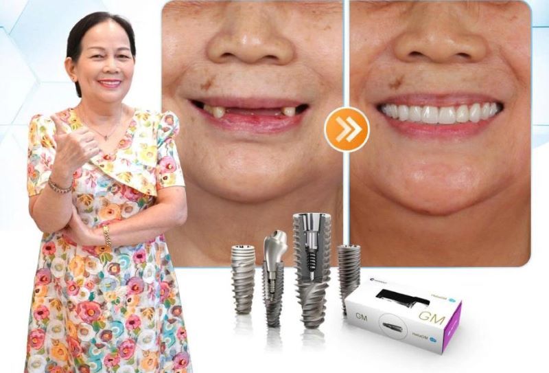 địa chỉ trồng răng implant tốt uy tín Phường Tân Phú TPHCM 2