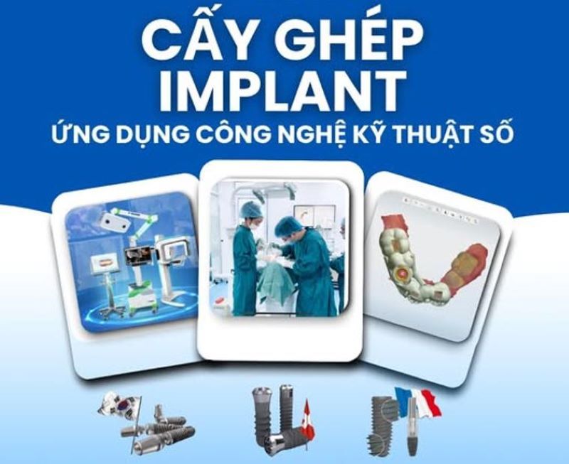 địa chỉ trồng răng implant tốt uy tín Phường Tân Phú TPHCM 4