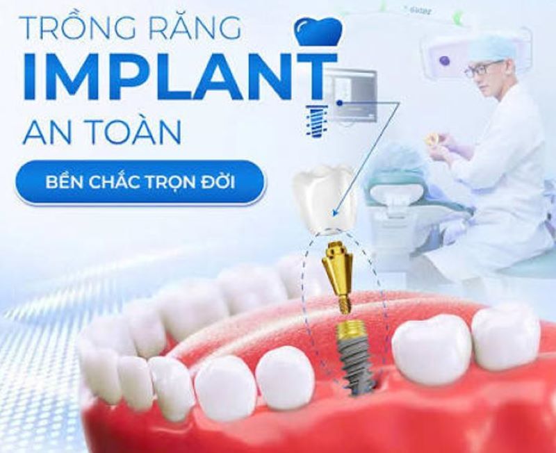Nha Khoa Minh Ý hướng đến phục hình Implant bền chắc