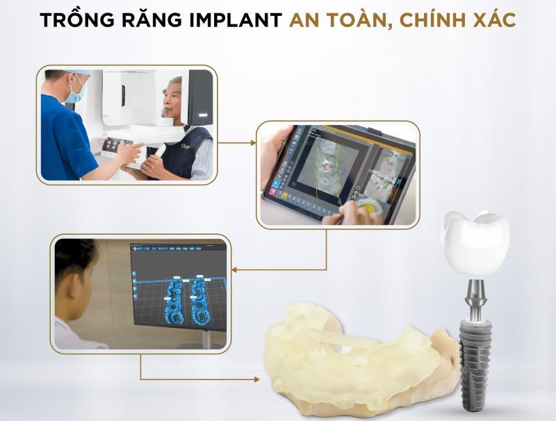 Nha khoa Kim ứng dụng công nghệ định vị Implant hiện đại