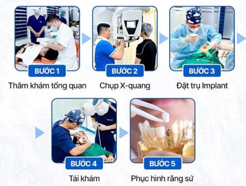 địa chỉ trồng răng implant tốt uy tín Phường Phú Thạnh TPHCM 4