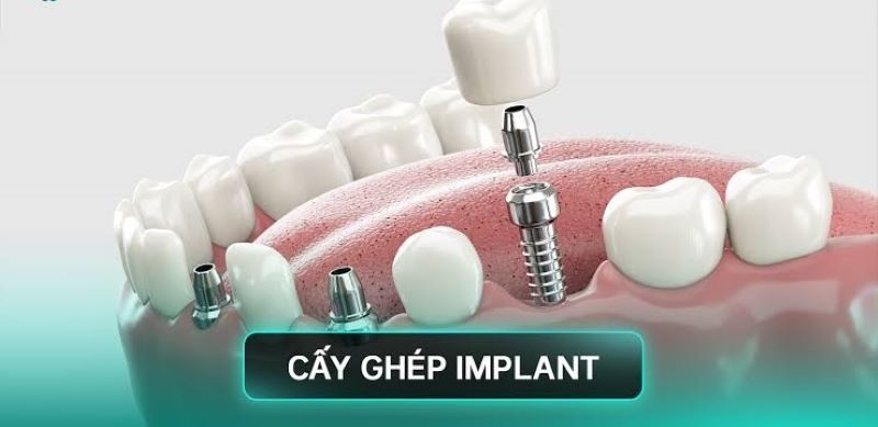 Nha khoa Đông Nam nổi bật hơn 20 năm cấy ghép Implant