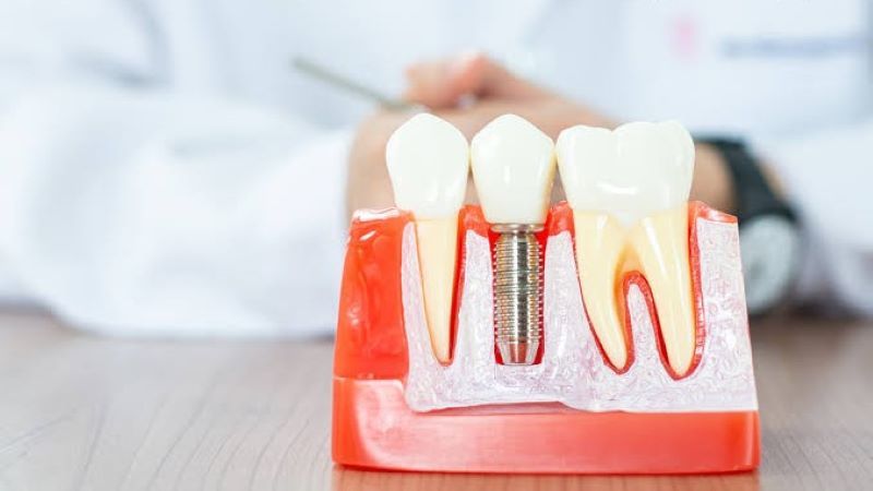 địa chỉ trồng răng implant tốt uy tín Phường Hiệp Bình TPHCM 2