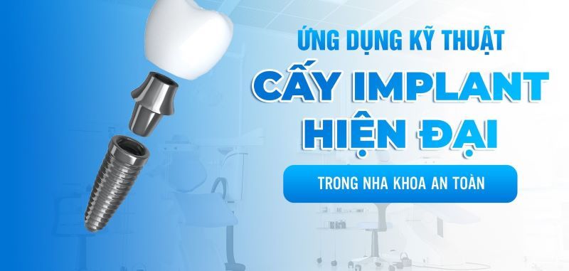 Lạc Việt Intech phát triển chuyên sâu kỹ thuật Implant an toan2 