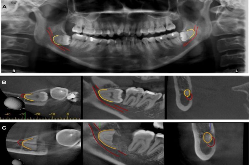 Phương Hạnh ứng dụng Cone Beam CT hỗ trợ cấy ghép