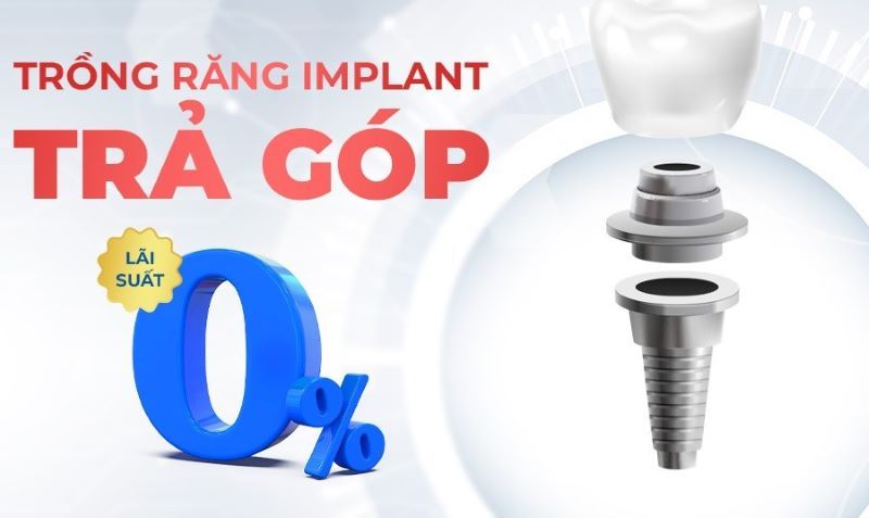 địa chỉ trồng răng implant tốt uy tín Phường Thủ Đức TPHCM 4