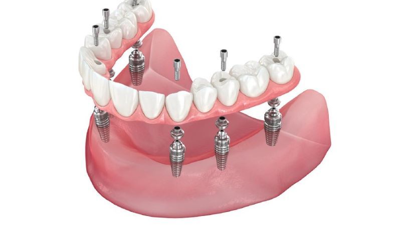 địa chỉ trồng răng implant tốt uy tín Phường Tam Bình TPHCM 2