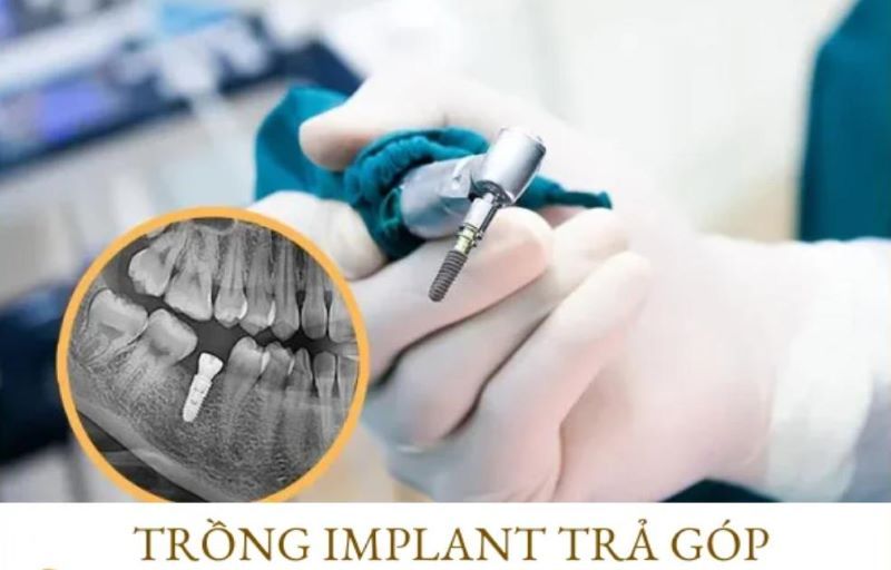 địa chỉ trồng răng implant tốt uy tín Phường Tam Bình TPHCM 4