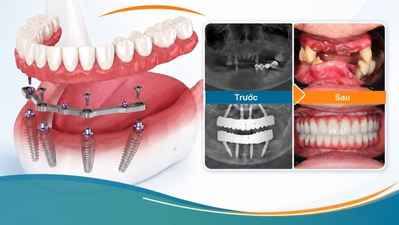 địa chỉ trồng răng implant tốt uy tín Phường Linh Xuân TPHCM