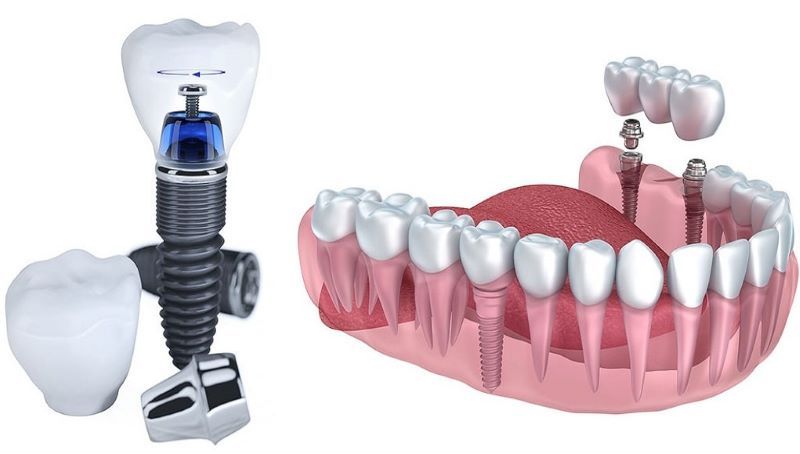 địa chỉ trồng răng implant tốt uy tín Phường Linh Xuân TPHCM 3