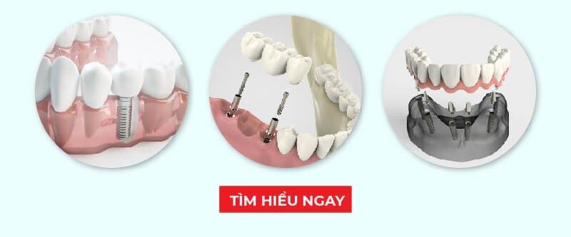 Nha khoa Kim cung cấp đa dạng giải pháp phục hồi răng implant 
