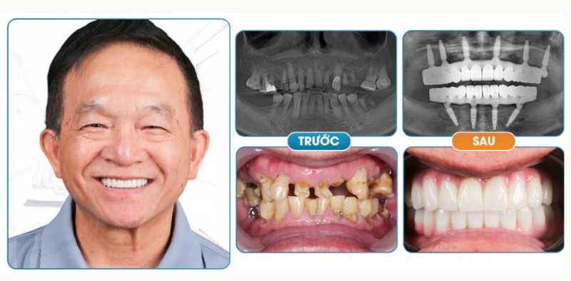 địa chỉ trồng răng implant tốt uy tín Phường Tăng Nhơn Phú TPHCM 2