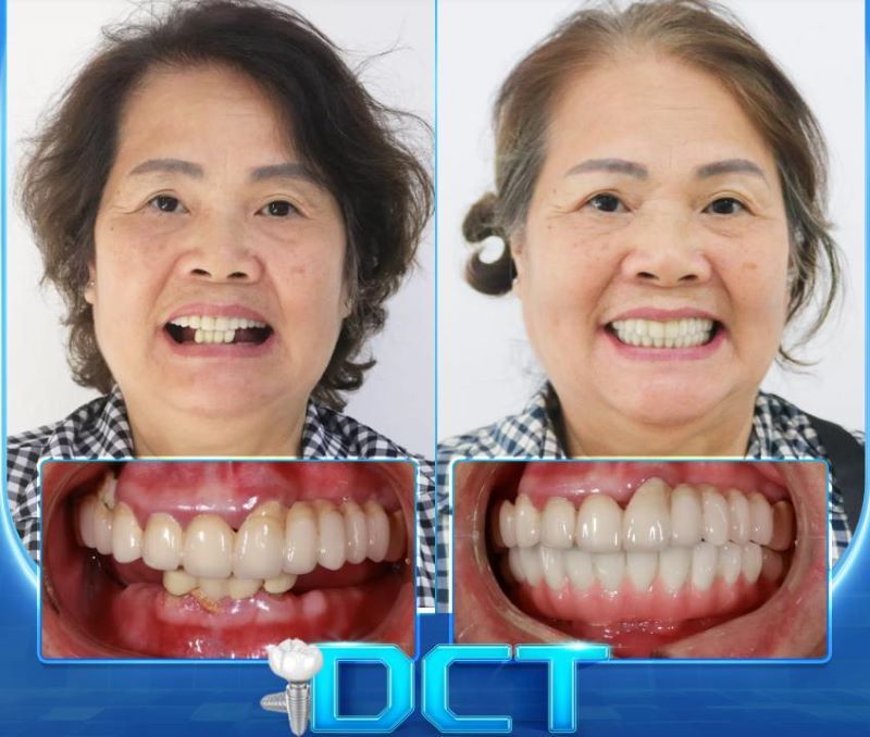 Lạc Việt Intech phát triển giải pháp Implant cá nhân hóa DCT