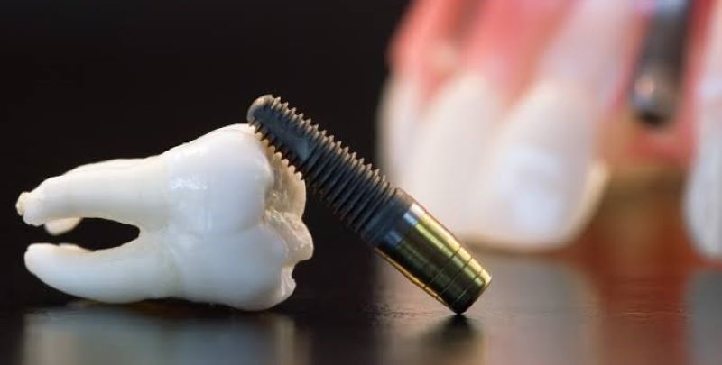 địa chỉ trồng răng implant tốt uy tín Phường Long Bình TPHCM