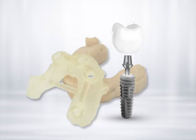 Worldwide ứng dụng công nghệ định vị Implant chính xác