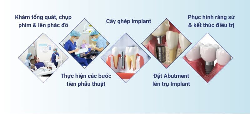 Nha Khoa Dentos nổi bật với quy trình Implant 5 bước