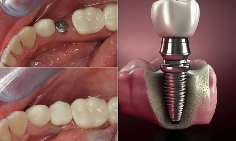 Peace Dentistry minh bạch vật liệu Implant chính hãng nhập khẩu