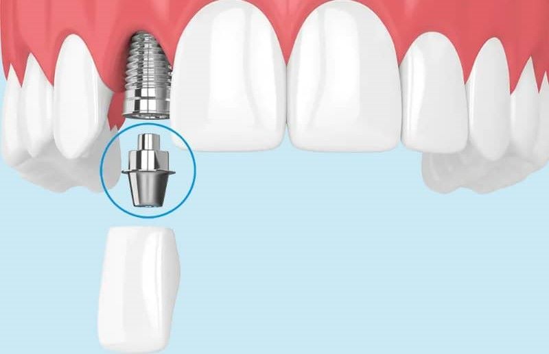 Nha khoa Minh Khai sử dụng trụ Abutment bằng công nghệ CAD/CAM