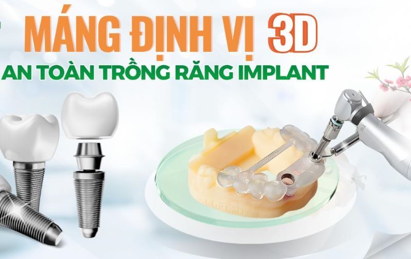 Nha khoa Phương Hạnh kiểm soát hiệu quả cấy ghép bằng máng 3D