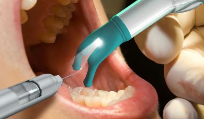 Nha khoa Đăng Lưu ứng dụng DentalVibe hỗ trợ giảm đau khi trồng implant