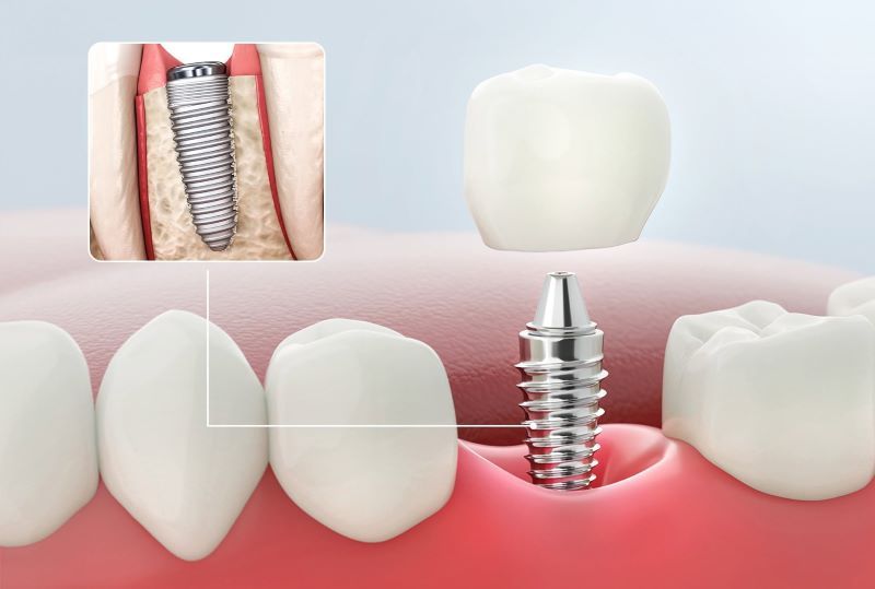 Xử lý implant chuyên sâu tại nha khoa Hoa Hồng Phương Đông 