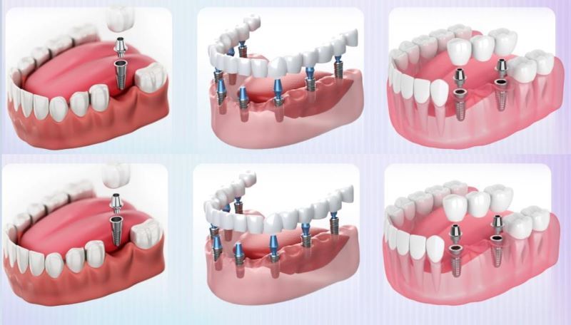 Nha khoa Parkway nổi bật với đa dạng phương pháp cấy ghép Implant 