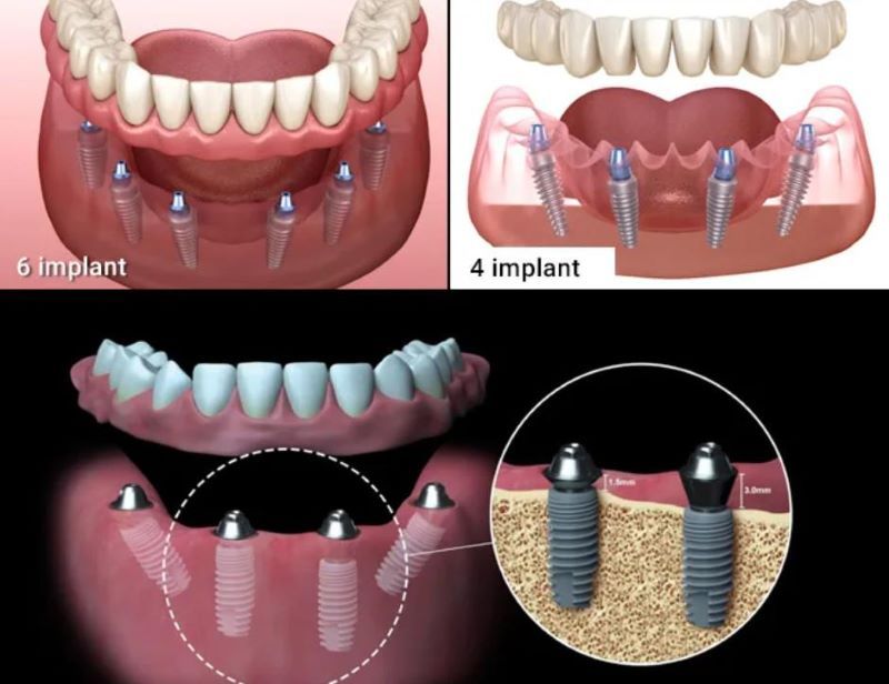 địa chỉ trồng răng implant tốt uy tín Phường An Phú TPHCM