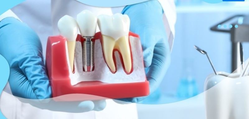 địa chỉ trồng răng implant tốt uy tín Phường An Phú TPHCM 5