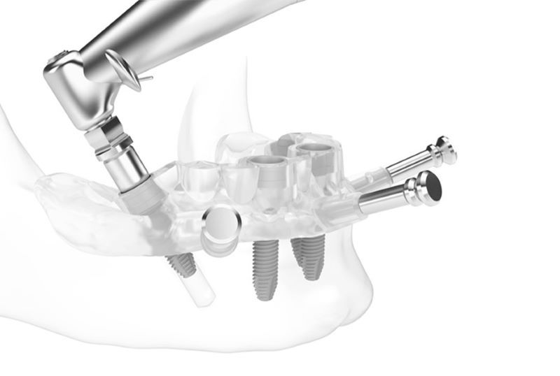 Nha khoa Việt Nha chú trọng tư vấn và kiểm soát vô trùng khi cấy ghép implant