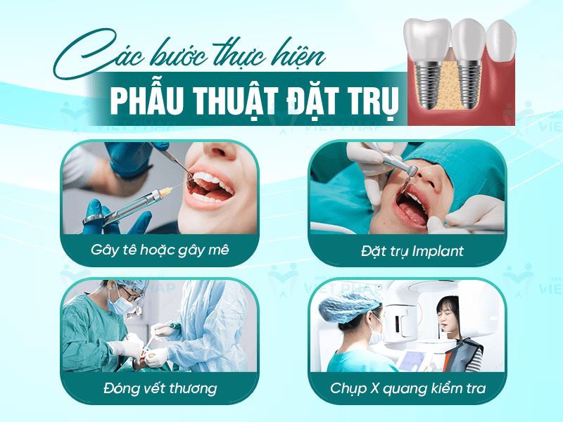 địa chỉ trồng răng implant tốt uy tín Phường Thuận Giao TPHCM 2