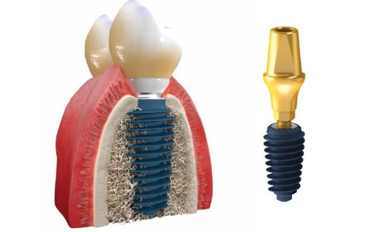 Nha Khoa Đại Nam sử dụng trụ Implant Megagen chính hãng