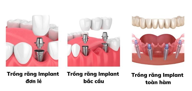 địa chỉ trồng răng implant tốt uy tín Phường Thủ Dầu Một TPHCM