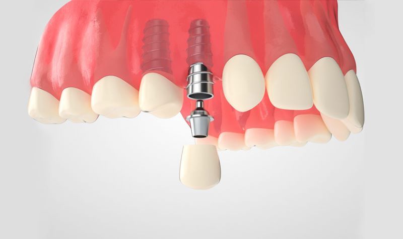 địa chỉ trồng răng implant tốt uy tín Phường Thủ Dầu Một TPHCM 2