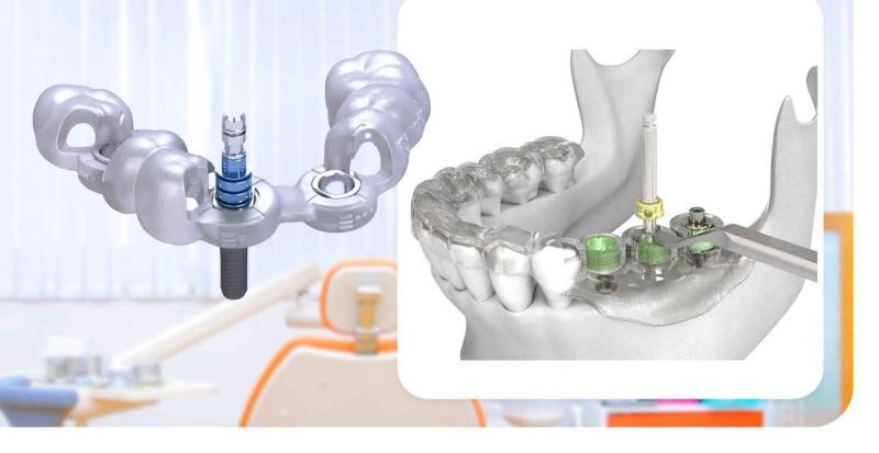 địa chỉ trồng răng implant tốt uy tín Phường Thủ Dầu Một TPHCM 3