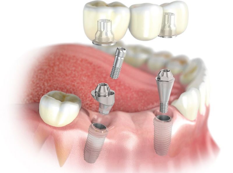 địa chỉ trồng răng implant tốt uy tín Phường Thủ Dầu Một TPHCM 4