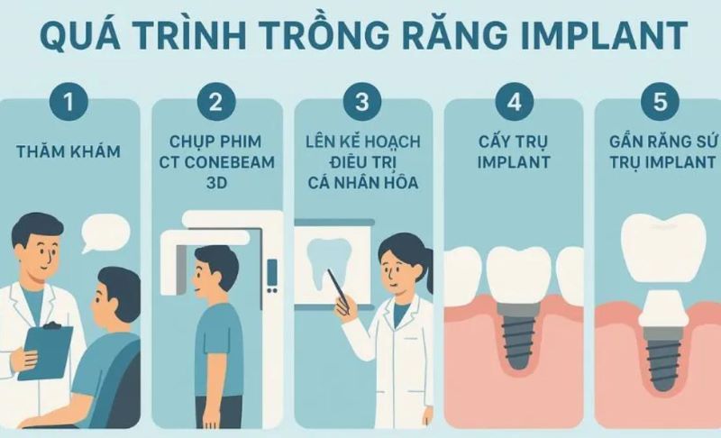Nha khoa TIMS xây dựng quy trình Implant gồm năm bước