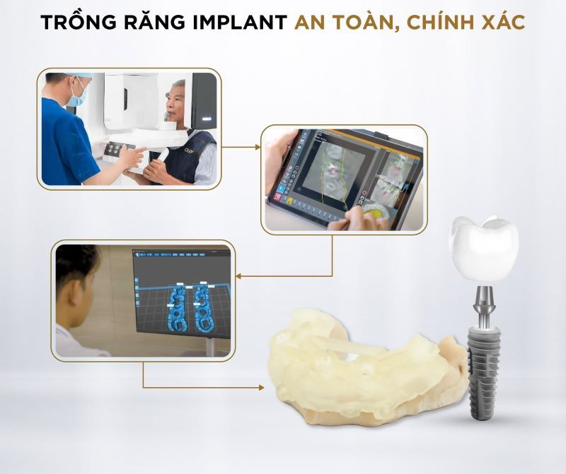 địa chỉ trồng răng implant tốt uy tín Phường Phú Lợi TPHCM