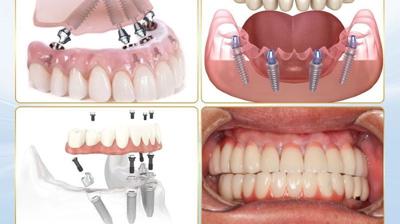 địa chỉ trồng răng implant tốt uy tín Phường Phú Lợi TPHCM 2