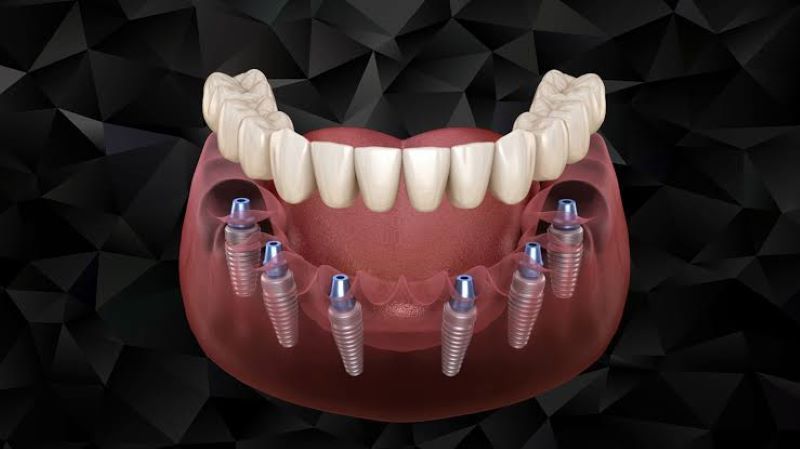 địa chỉ trồng răng implant tốt uy tín Phường Phú Lợi TPHCM 5