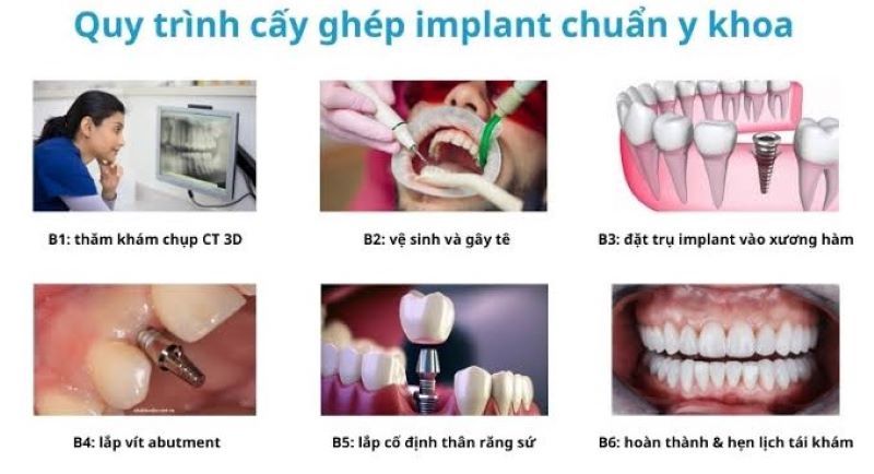 địa chỉ trồng răng implant tốt uy tín Phường Chánh Hiệp TPHCM