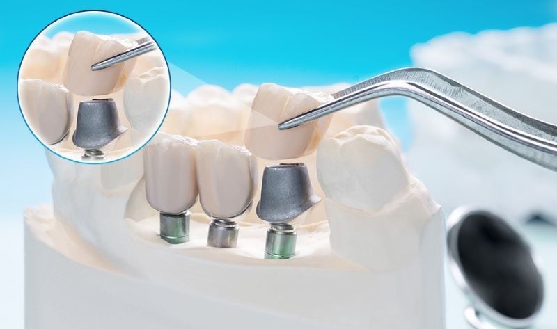 địa chỉ trồng răng implant tốt uy tín Phường Bình Dương TPHCM 3