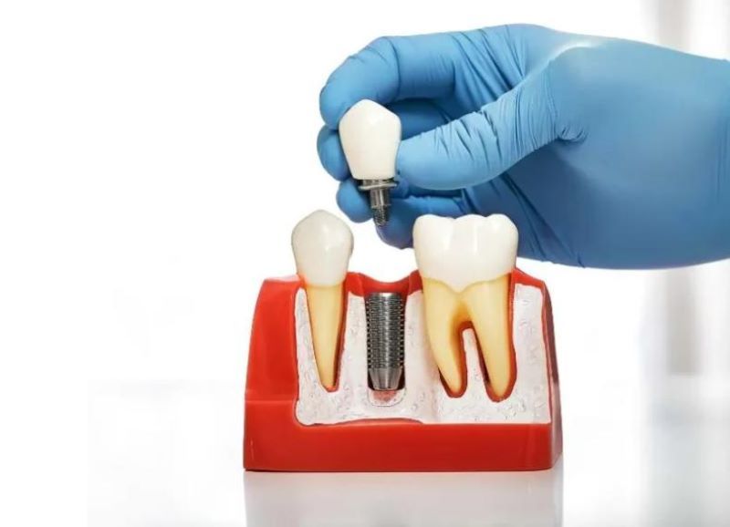 địa chỉ trồng răng implant tốt uy tín Phường Bình Dương TPHCM 5
