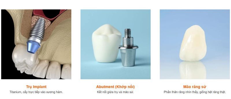 Nha Khoa Quốc Tế Volcano phát triển dịch vụ Implant từ năm 2010