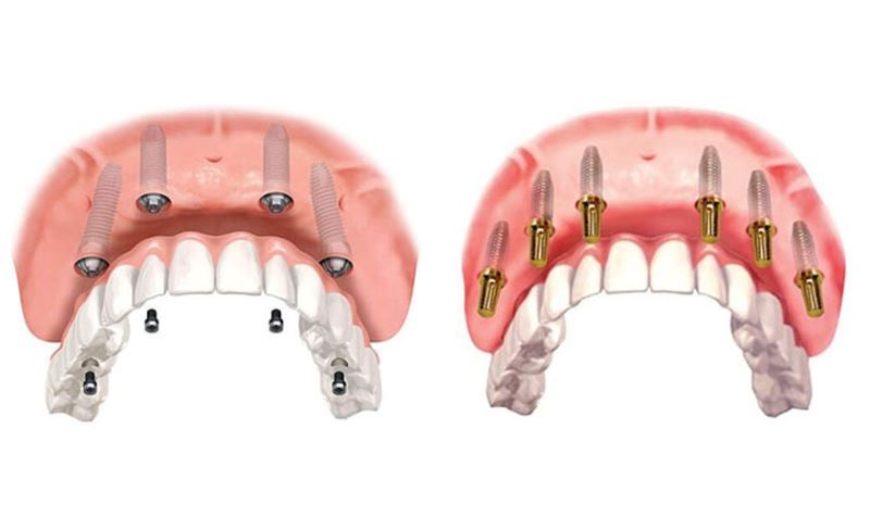 Nha Khoa Paris phát triển dịch vụ Implant chuyên sâu
