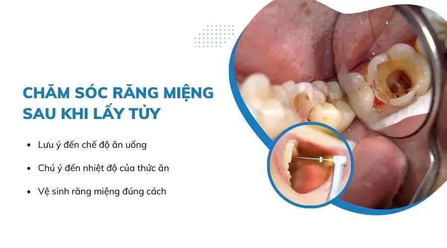 Chăm Sóc Răng Miệng Sau Khi Lấy Tủy