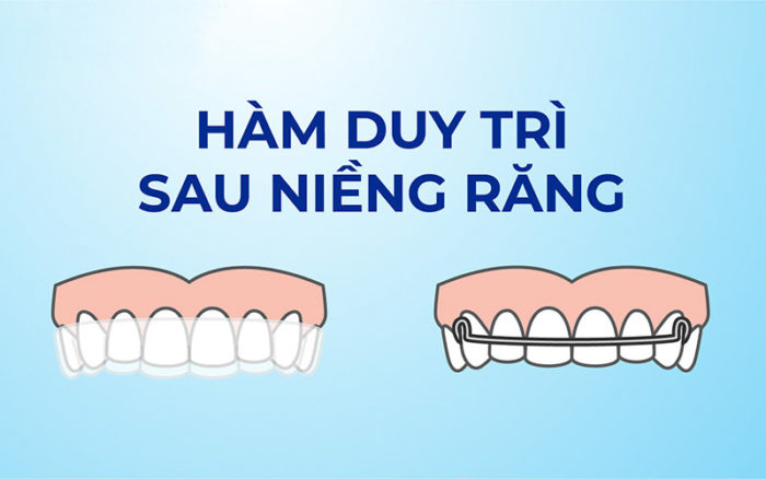Hàm duy trì là một khí cụ nha khoa